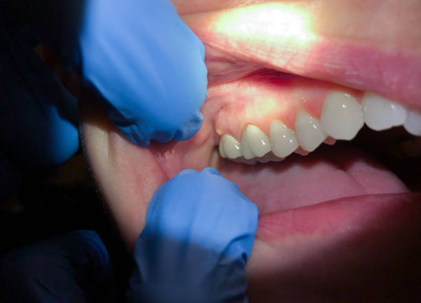 Best Emergency Treatment for Dental Infections or Abscesses in Duquesne, MO